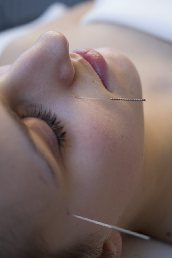 Akupunktur mit feinen Nadeln zur Behandlung von Verspannungen in einer Praxis in Bern