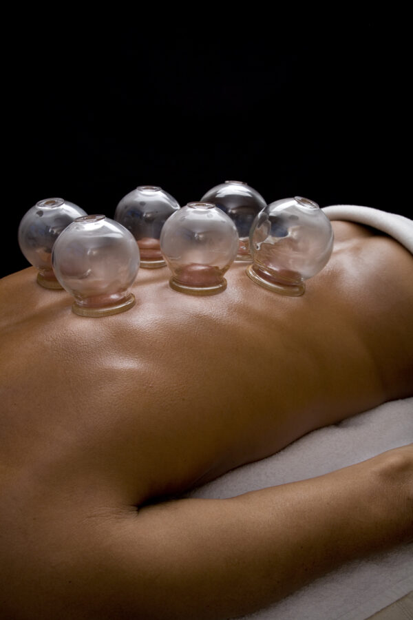 Schröpfbehandlung in einer TCM Praxis in Bern zur Lösung von Muskelverspannungen