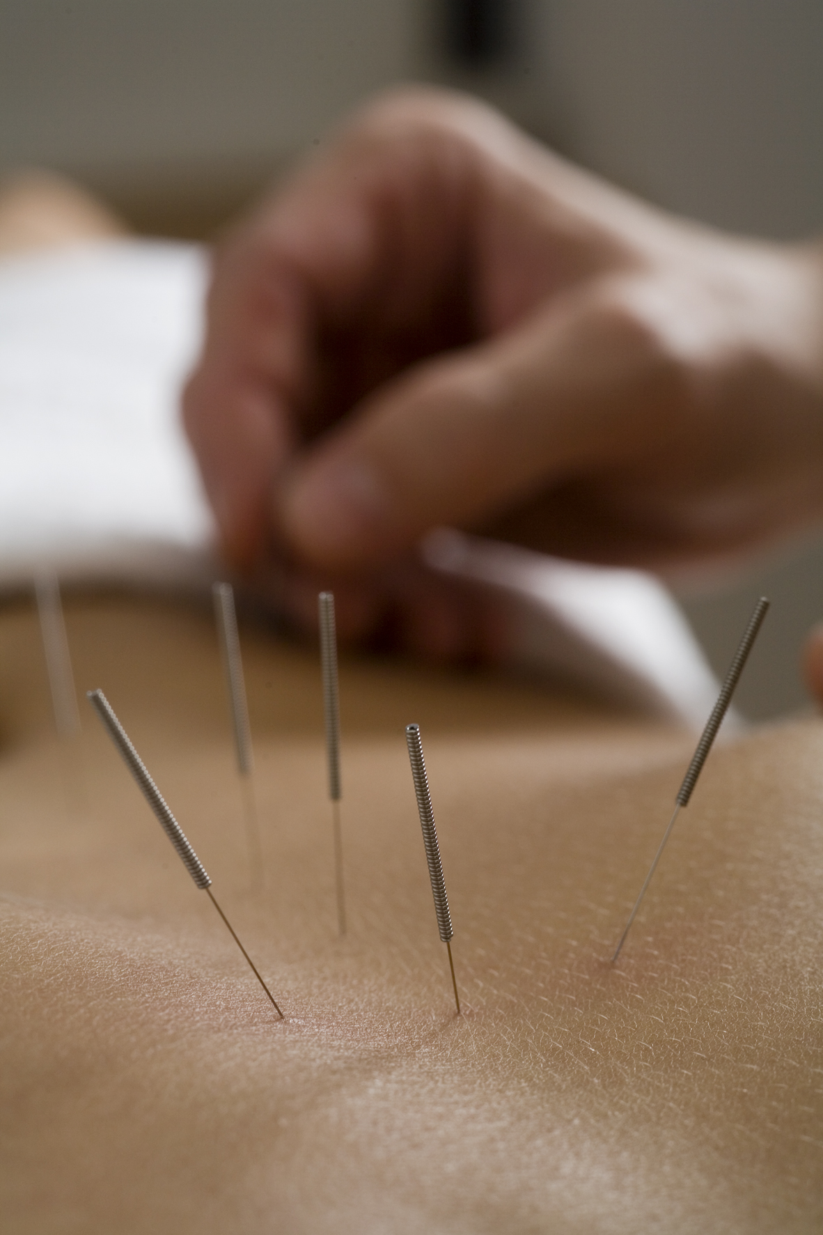 Gezielte Akupunkturpunkte werden mit feinen Nadeln stimuliert zur Unterstützung des Energieflusses im Körper