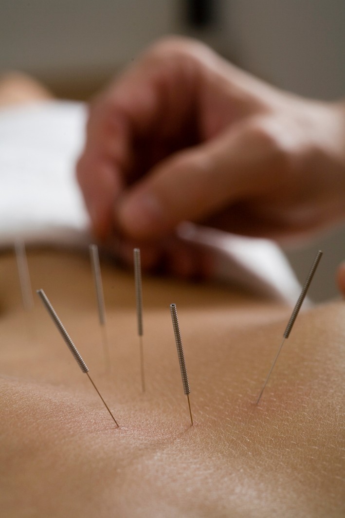 Gezielte Akupunkturpunkte werden mit feinen Nadeln stimuliert zur Unterstützung des Energieflusses im Körper